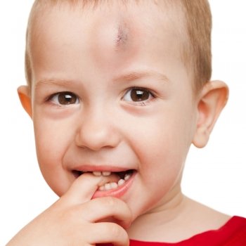 Tres falsos mitos de los traumatismos craneales en niños