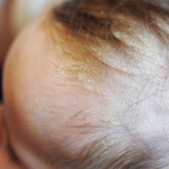 Costra láctea en bebés: preguntas y respuestas