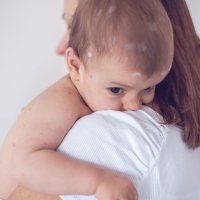 Cómo diferenciar sarampión, varicela y rubéola en los niños