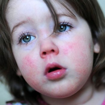 Enfermedad del bofetón o eritema infeccioso en bebés y niños