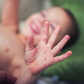 Enfermedad de mano-pie-boca en los niños. Síntomas y tratamiento