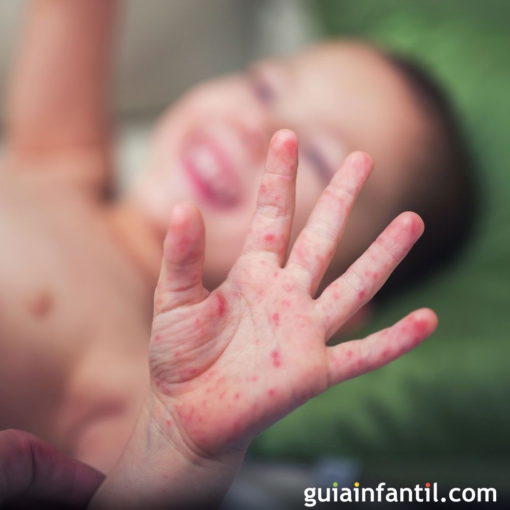 Enfermedad de mano-pie-boca en los niños. Síntomas y tratamiento