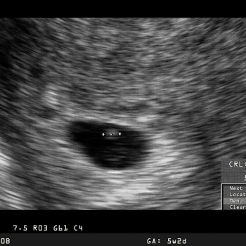 Huevo huero o embarazo anembrionario. Cuando la gestación es fallida