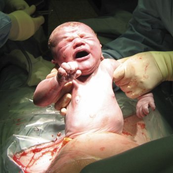 'Solamente hay que hacer parto por cesárea si es necesario'