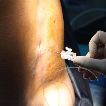 ¿Parto con epidural o sin ella?