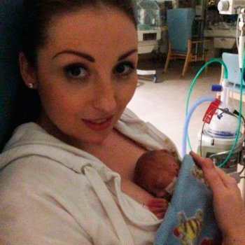 El bebé más prematuro del mundo antes y después