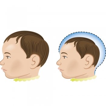 Un pesticida y no el virus Zika asociado a los casos de microcefalia en bebés