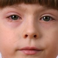 Qué nos dicen los ojos de la salud de los niños