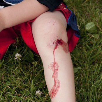 Heridas y quemaduras en los niños