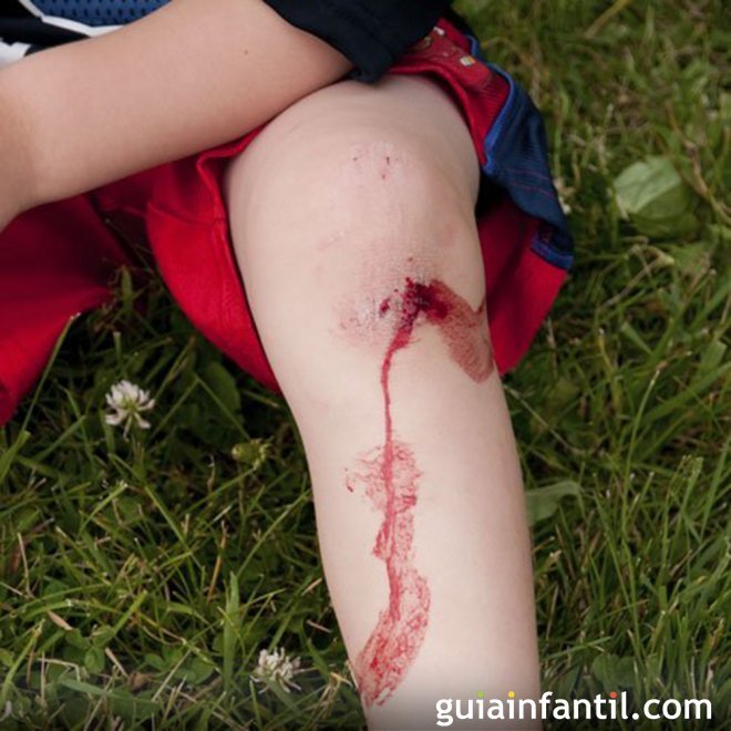 Heridas y quemaduras en los niños