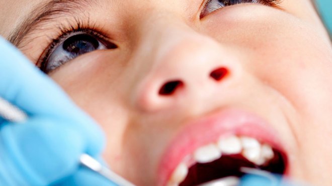 El sellado de los dientes, prevención contra la caries infantil