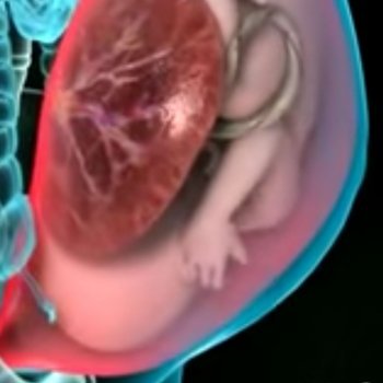 Animación de un parto por cesárea