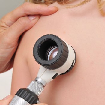 Lunares en la piel de los niños. Protección al sol