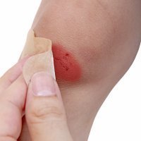 Cómo saber si una herida está infectada y cómo curarla