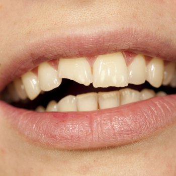 Qué hacer ante la rotura del diente de un niño