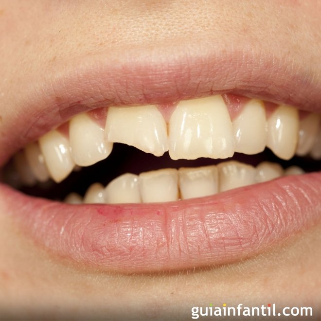 Qué hacer ante la rotura del diente de un niño