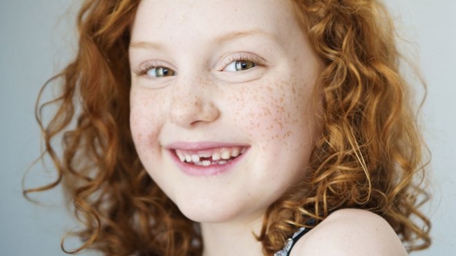 Blanqueamiento de los dientes de los niños