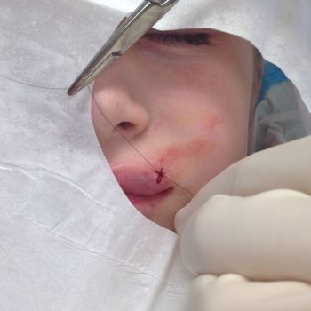 Cuándo una herida necesita puntos de sutura