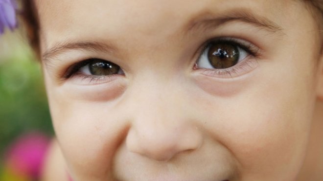 Tratamiento para el estrabismo infantil