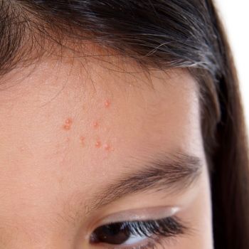Qué son los moluscos en la piel de los niños