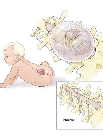 Bebé con espina bífida Bebé con espina bífida