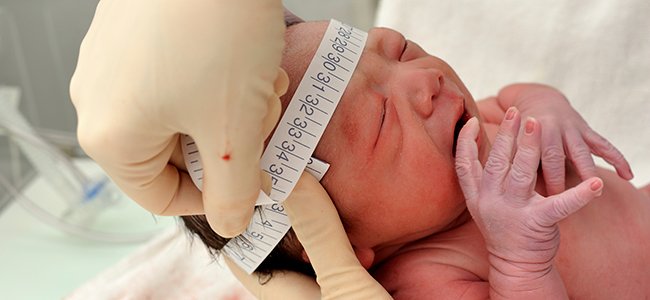 Bebés con microcefalia a causa del virus Zika