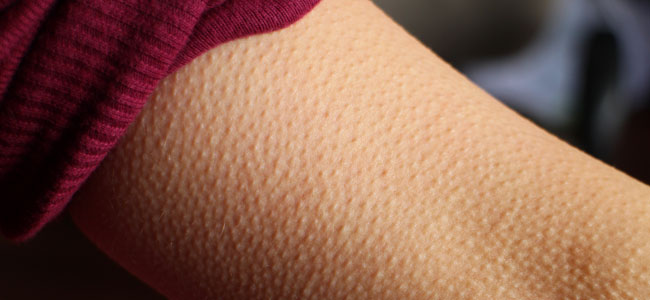 Por qué se pone la piel de gallina Por qué se pone la piel de gallina