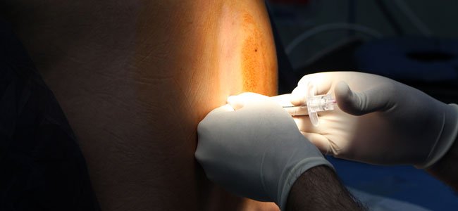 Así se aplica la epidural a la embarazada Así se aplica la epidural a la embarazada