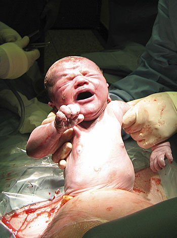 Cuándo es necesario el parto por cesárea Cuándo es necesario el parto por cesárea