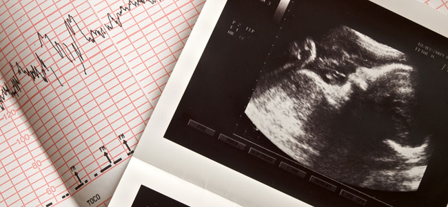 Hipotiroidismo en el feto