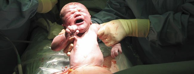 Qué es una cesárea