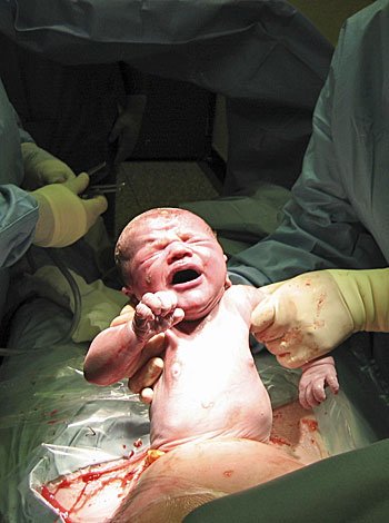 Italia es el país europeo con más parto por cesárea