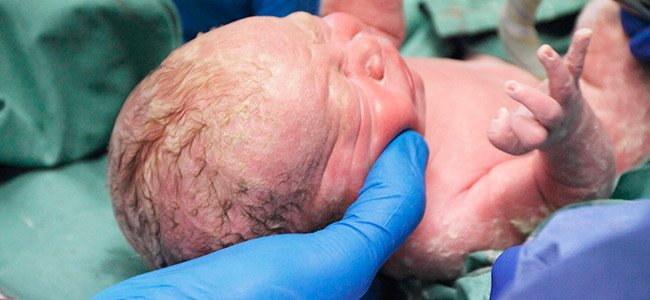 El parto por cesárea