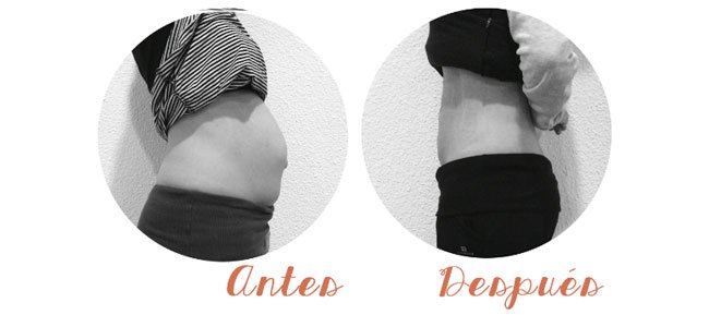 Diástasis tras embarazo Tripa tras embarazo