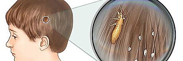 Encuesta sobre los piojos de los niños