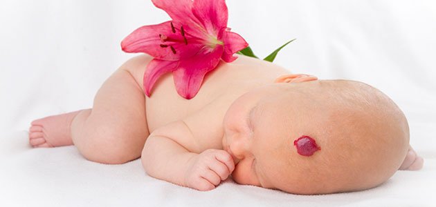 Гемангиома на коже фото и лечение Hemangiomas en la piel del bebé