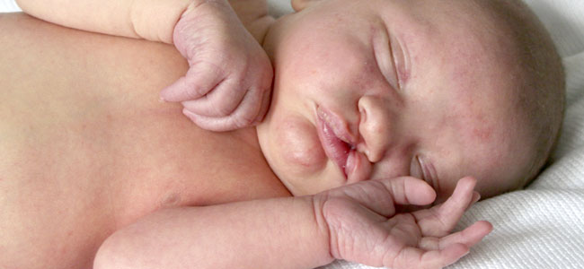 Cómo se trata el labio leporino en bebés