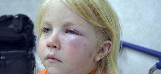 Reacciones alérgicas a las picaduras de insectos en los niños Reacciones alérgicas a las picaduras de insectos en los niños