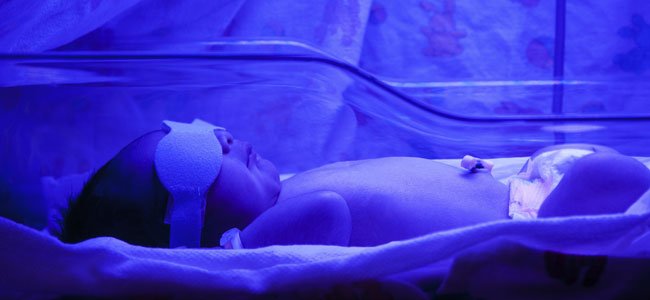 La ictericia en recién nacidos Recién nacido con luz ultravioleta