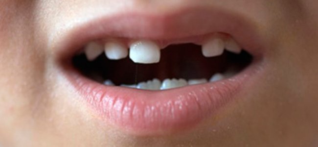 Rotura de dientes en niños